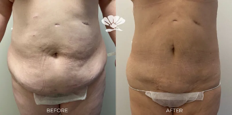 lipo perth